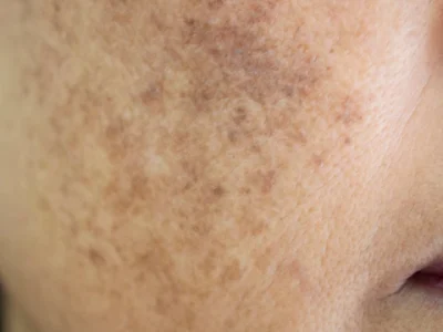 Skin Specialist in Gwalior