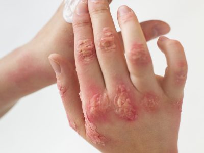 Skin Specialist in Gwalior